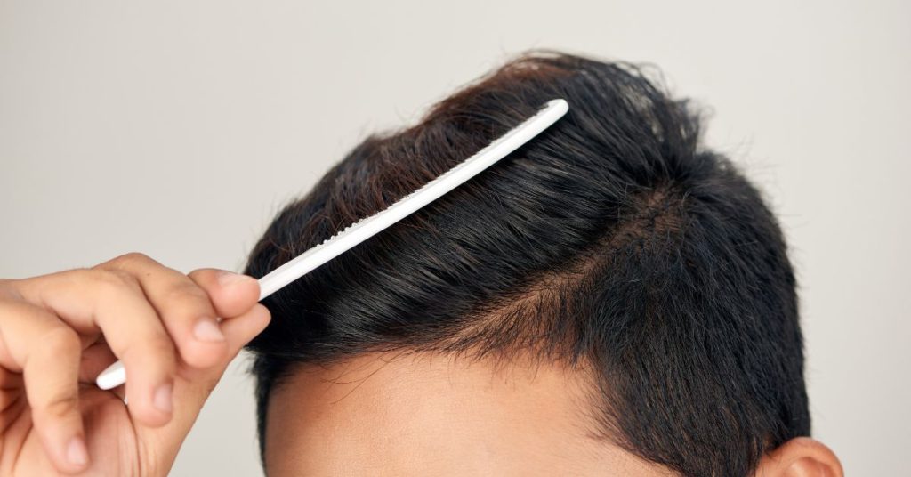 Restore Your Confidence with Neograft Hair Transplant